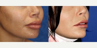 Upper and Lower Lip Silicone Removal surgery for Firmer Healthier Contour - A more natural lip appearance can often be achieved by carefully removing harmful foreign material from the lips. Our patient is a 28-year-old White female who came to Dr. J. Timothy Katzen because of previously injected foreign bodies in both her upper and lower lips. She was most concerned about the retained material, the scar tissue surrounding it, and the risk of granulomas and associated cancer. To treat these issues, Dr. Katzen performed silicone injection removal of the lips under general anesthesia. In this procedure, the abnormal injected material is carefully identified within the lip tissue and surgically excised. At the same time, any problematic scar tissue is also addressed to help restore a smoother contour. Lip foreign body removal is an advanced reconstructive procedure because the surgeon must remove harmful material without overly disrupting the natural architecture of the lips. These injections can cause chronic swelling, firmness, nodules, uneven shape, and visible lip distortion that cannot be corrected without surgery. By removing the foreign bodies and refining the tissue, this procedure can improve both safety and appearance. Her after photos were taken just 2 weeks after surgery and already show remarkable results, including better symmetry, softer-looking lips, and a healthier overall contour. Since healing is still in the early phase, her progress is especially impressive and should continue to improve over time.