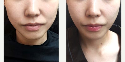 45-54 year old woman treated with Radiesse, Juvederm - Before and after images show patients aged 3055 who underwent advanced lifting treatments such as Titanium Lifting, Ultherapy, and Thermage. These procedures are designed to improve skin firmness, refine facial contours, and support collagen regeneration, helping achieve naturally lifted and balanced results tailored to each patients skin condition