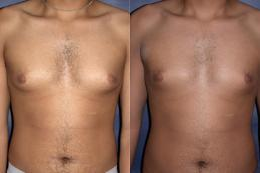 Male Breast Reduction / Gynecomastia - 
	Gynecomastia or male breast reduction corrects the over-developed or enlarged breasts of men. Breast Reduction is done under general anesthesia. Incisions are made around the pigmented area (the nipple areolar complex) and extend vertically below the nipple and in the fold under the breast. The nipple areolar complex is moved upward to the desired location, while excess breast tissue, skin, and fat are removed.
