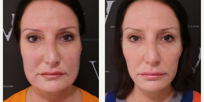Fat melting injections to redefine facial contours - The Fat Loss Facelift is a non-surgical treatment that removes unwanted facial fat using Deoxycholate injections (the key ingredient in products such as Aqualyx and Kybella). The injected product causes the fat cells to expand and break down, which are then naturally, safely eliminated from the body through natural processes. Slimmer face and more defined profile is achieved in one single session with final results showing 12 weeks after the treatment.
