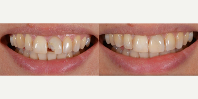18-24 year old woman treated with Tooth Repair, Dental Bonding - This patient came to the clinic with a broken tooth, this is one day procedure, in 1h she was free to smile happily again!