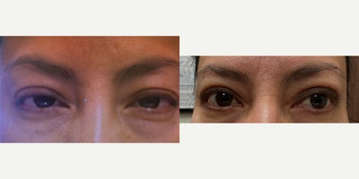 35-44 year old woman treated with ptosis repair blepaharoplasty both upper lids - ptosis repair blepaharoplasty both upper lids