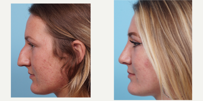 18-24 year old woman treated with Rhinoplasty - This patient was bothered by the hump on her nose and not being able to breath well. Dr. Balikian preformed a Septoplasty with Rhinoplasty. After only 6 months after surgery can breath perfectly and is thrilled with her results. Her swelling will continue to subside over the next 6 months.