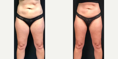 Woman treated with CoolSculpting - Woman treated with CoolSculpting