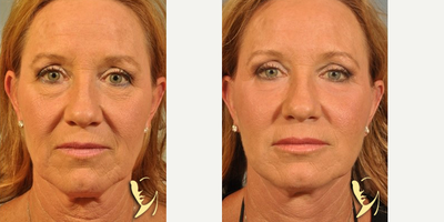 55-64 year old woman treated with Phenol Peel - HETTER PEEL SKIN RESURFACING, Baker-Gordon Phenol Peel by Burke Robinson MD, FACS