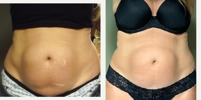 35-44 year old woman treated with truSculpt iD - Trusculpt ID abodmen