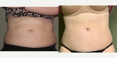 trusculpt ID abdomen - 20 year old trusculpt id abdomen