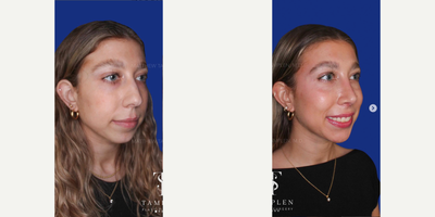 Woman treated with Rhinoplasty - Beautiful results just 6 weeks after Rhinoplasty.This patient is breathing great and couldnt be happier with her new look! The smile says it all!