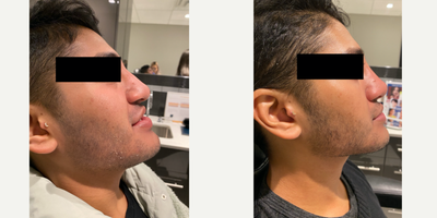 18-24 year old man treated with Nonsurgical Nose Job - Cindy used Restylane Lyft to straighten some minor bumps and lift the overall appearance.