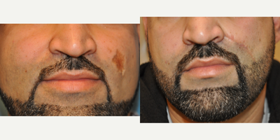 35-44 year old man treated with Scar Removal - 36 year old male underwent scar revision surgery under local anesthesia.