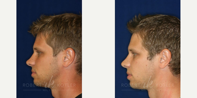 Permanent Non-surgical Rhinoplasty - Raising low bridge, improving tip structure and obscuring hump with Permanent Filler.