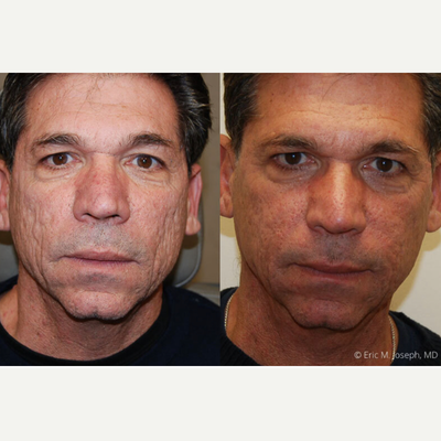 45-54 year old man treated with Silikon 1000 - Microdroplet Silikon-1000 injections were used for permanent correction of depressed acne scars. Thank you.