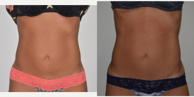 45-54 year old woman treated with CoolTone - Our 47 year old patient had four Cooltone treatments each to her Abdomen and Butt. The after photos were taken directly after her 4th Cooltone session.