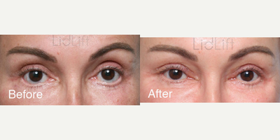 55-64 year old woman treated with Canthoplasty - 55 year old with prior unsatisfactory upper and lower eyelid surgery. Staged bilateral midface lift, hand carved ePTFE rim implant, hard palate graft, lateral canthoplasty. Subsequent bilateral crease lowering surgery and ptosis repair.