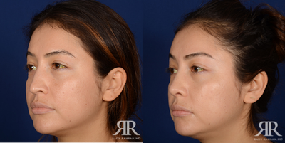 Rhinoplasty - Rhinoplasty