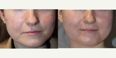 25-34 year old woman treated with PRP Injections, Vampire Facial - 13130: vampire facial25 yo, F, 55, 127lbs, G0P0