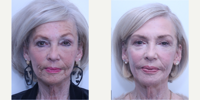 65-74 year old woman treated with Eyelid Surgery, Halo Laser, Botox - Upper blepharoplasty, Contour TRL, HALO, and neuromodulators performed by Dr. Thomas Buonassisi at 8 West Clinic, Vancouver, BC