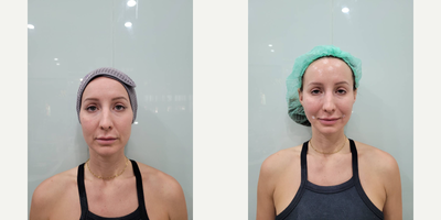 25-34 year old woman treated with Restylane, Restylane Silk, Restylane Refyne, Restylane Defyne, Restylane Contour, Restylane Ly - A 28-year-old woman has been considering getting cosmetic fillers to address a few concerns she has with her appearance. She's noticed some fine lines around her mouth and eyes and has also become self-conscious about the hollowing under her eyes and the asymmetry in her cheeks. After consulting with a qualified practitioner, she's decided to receive treatment with Restylane fillers