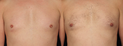 35-44 year old man treated with Nipple Reduction - 36 yo male wanted less prominent nipples. Dr. Gervais performed a star pattern nipple reduction with local anesthetic. His post-op photos are at 6 weeks.