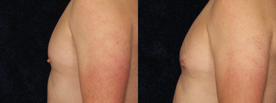35-44 year old man treated with Nipple Reduction - 36 yo male wanted less prominent nipples. Dr. Gervais performed a star pattern nipple reduction with local anesthetic. His post-op photos are at 6 weeks.