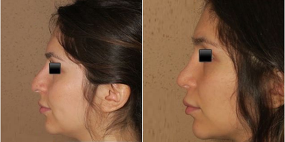Woman treated with Rhinoplasty - Woman treated with Rhinoplasty