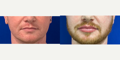 25-34 year old man treated with Lip Augmentation - Immediately after multiple syringes of lip filler over the course of a year done by PA Steve.