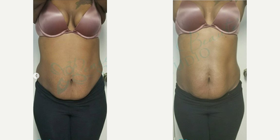 Woman treated with Lipodissolve - Woman treated with Lipodissolve