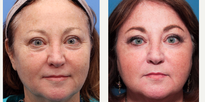 55-64 year old woman treated with Pixel Laser - Facial skin tightening and improvement in skin tone after two treatments with Pixel Laser.