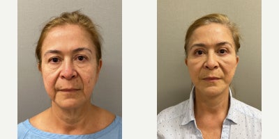 65 year old woman treated with NaturalLift, upper and lower eyelid blepharoplasty, fat transfer to lower eyelids - 65 year old woman treated with NaturalLift, upper and lower eyelid blepharoplasty, fat transfer to lower eyelids