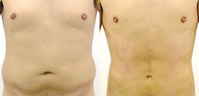 35-44 year old man treated with Liposculpture - 35-44 year old man treated with Liposculpture