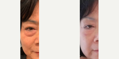 Woman treated with Microneedling - Eliminate those pesky undereye bags with our new treatment, Agnes RF. The precision microneedling and the delivery of the concentrated radiofrequency stimulates fibroblasts which generate collagen and produce results that can be similar to a face or neck or eyelift.
