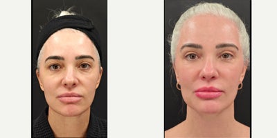 45-54 year old woman treated with Eyelid Surgery, Facial Fat Transfer, Halo Laser - Perimenopausal female requesting facial rejuvenation. Starting to notice boxiness of face and jawline, upper eyelid excess and loss of skin luminosity. Dr. Daniali performed a regenerative fat transfer, profractional laser resurfacing and upper blepharoplasty. Fat transfer was performed through out the face: temples, forehead, glabella, infra brow, mid face, and jawline to transfer boxy facial shape to a heart shaped facial shape that is more rejuvenating. Fat transfer and laser resurfacing regenerated her skin, returning back luminosity, glow, and turgor of facial tissues. Fat transfer also provided more jawline definition & more defined neckline.