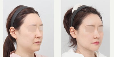35-44 year old woman treated with Jaw Reduction, Cheekbone Reduction, Chin Liposuction, AccuLift - She had mandible jaw reduction, cheekbone reduction, genioplasty, chin liposuction and thread lifting for the neck