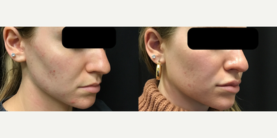 Pre & Post Female with Acne after Chemical Peel - This young female has been struggling with acne. She has completed a series of 3 treatments using the PCA Chemical peels, and there is already significant reductions in active acne and discoloration.