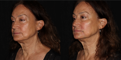 65-74 year old woman treated with Bellafill, Revanesse - This 67 year old woman underwent volume restoration with Bellafill-m3 syringes for the temporal hollows, plus 3 syringes per side for the cheeks, nasolabial folds, oral commissures and marionette/chin region. A total of 9 syringes. A syringe of Revanesse Versa Lips was then used to softly enhance her lip border and correct her vertical lip lines. Her results will continue to improve over time as she builds collagen in response to the Bellafill, and will be very long lasting as well. Minor swelling is present as the photos were done immediately after the procedures.