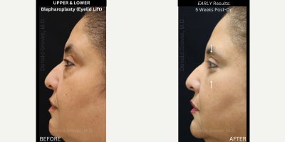 UPPER & LOWER Blepharoplasty (Eyelid Lift Surgery) | Undereye Bags | Bulging | Fat Herniation | Loose Excess Skin | Look Tired | - My patient had SEVERE lower eyelid bags that were getting worse over time. She also had excess upper eyelid skin. She was constantly being told she looks tired and she wanted to rejuvenate her face to get a more youthful appearance before her wedding in a few weeks! She was MOST bothered by her eyelids. - - - To correct her problems, I performed an upper and lower blepharoplasty (eyelid lift). - - - She required:  Precise removal of her excess UPPER eyelid skin, carefully hiding the scar in her natural eyelid crease (so it would heal invisibly)  Careful removal of the herniated LOWER eyelid bulging fat (which cause the lower lid bags)  Suspension of the ORBICULARIS muscle to the bony orbital rim- to restore the muscle anatomy to a more natural position and decrease the likelihood of recurrent bulging after surgery  Delicate suture placement to close the incisions in such a way that they heal properly and the final scars are basically invisible - - - Her case highlights why you should ONLY trust your face with an experienced Facial Plastic Surgeon! 