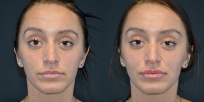 18-24 year old woman treated with Restylane Silk - 24 year old female received Restylane Silk filler in her lips