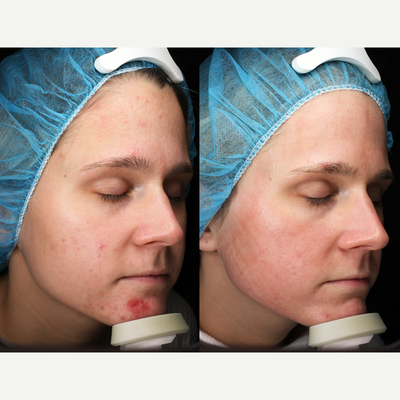 35-44 year old woman treated with Pearl Laser - 35-44 year old woman treated with Pearl Laser
