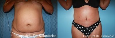 Tummy Tuck Revision  - 37 year old woman after revision tummy tuck with liposuction. results noted after 3 months.