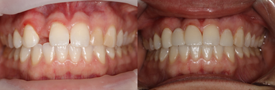 18-24 year old man treated with Dental Bridge - 19 year old female born missing peg lateral