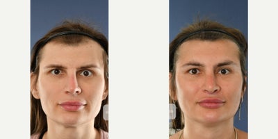 35-44 year old transgender woman treated with Transgender Facial Feminization Surgery, Facial Feminization Surgery, Rhinoplasty, - Facial feminization surgery including a Type 3 forehead reconstruction (forehead/brow bone recontouring with setback) to soften the upper face, combined with rhinoplasty to refine the nose and improve overall facial harmony.Photos show the result after healing; individual results and recovery times may vary.