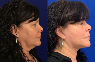 60 year old woman treated with Buccal Fat Removal - 60 year old patient 8 weeks post Buccal Fat Removal, Upper & Lower Blepharoplasty, Facelift, Necklift, Fat Transfer, Submental Liposuction and CO2 laser