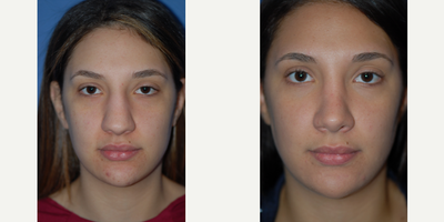 25-34 year old woman treated with Septoplasty - 25-34 year old woman treated with Septoplasty