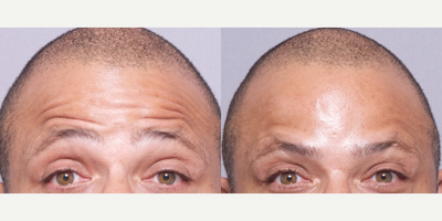 35-44 year old man treated with Dysport - This patient came in wanting less dynamic movement at the forehead. After visiting with Dr. Ho, the patient received a Dysport treatment.
