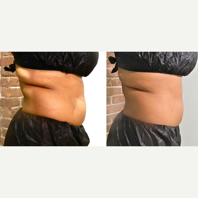35-44 year old woman treated with i-Lipo - Treated with 12 sessions of iLipo
