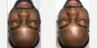 Woman treated with HydraFacial - Woman treated with HydraFacial.