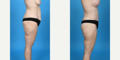 35-44 year old woman treated with Abdominal Etching, Body Lift, Diastasis Recti Repair, Drainless Tummy Tuck, Liposculpture, Lip - before and after breast lift with breast augmentation. This patient had significant weight loss and wanted a breast lift to lift and shape her breasts and a breast augmentation to add volume. I did a breast lift repositioning her nipple/areolar complex to the correct position on the chest and shaping her breast. For the augmentation is used a silicone gel gummy bear SoftTouch 345cc moderate profile.
