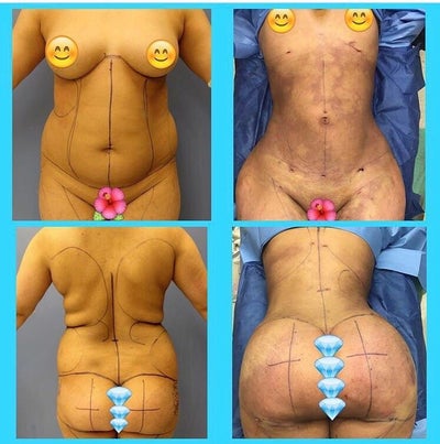 Breast Reduction - Dr. Rafael Arenas Plastic Surgery