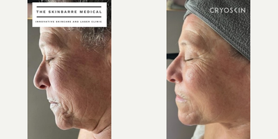 Woman treated with Cryoskin - Woman treated with Cryoskin