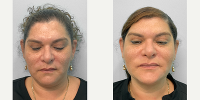 45-54 year old woman treated with Kybella - This woman in her early fifties desired improvement to the appearance of her neck. She met with Joy, our nurse injector, and decided to proceed with two treatment rounds of Kybella. She looks wonderful and has been very pleased with her results.